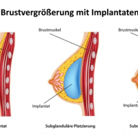 Brustvergrosserung mit Implantaten