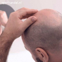 Haartransplantatie in Amsterdam